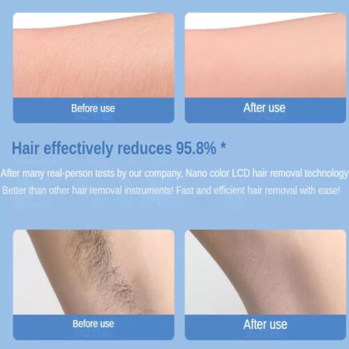 Epilator Sa Nano Kristalima Za Glatku Kožu